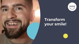Veneers Without Surgery | Clip On Veneers | Instasmile