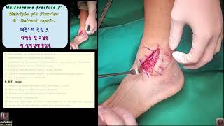 496.(의사용.Maisonneuve fx.통합24분) 3. Surgery: Multiple pinning & Deltoid lig repair (1.~14) [강찬.충남대병원]