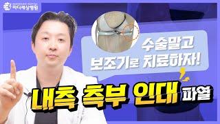 [무릎 통증] 내측측부인대 파열, 수술 대신 보조기로! 치료하는 방법