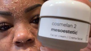 My unbelievable 30 day Cosmelan Peel journey!