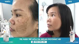 Điều trị nám hiệu quả với phác đồ độc quyền của bác sĩ - Bằng công nghiện hiện đại nhất thế giới