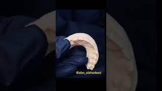 CAD/CAM Zirconia Denture ▏Vsmile