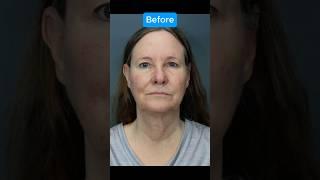 INSANE FACELIFT TRANSFORMATION (Journey)