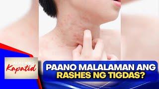 Measles: signs, symptoms, treatment