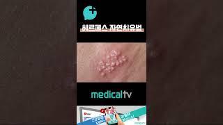 헤르페스 자연치유법