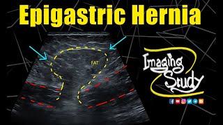 Midline Epigastric Hernia || Ultrasound || Case 320