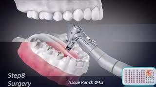 Osstem Implant All Kits