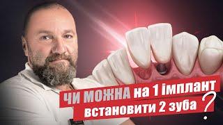  Чи можна на 1 імплант встановити 2 коронки?