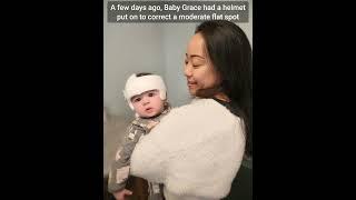 Life Update: Baby Grace Gets A Plagiocephaly Helmet