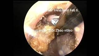 3 simple cholesteatoma clearance in the external auditory canal, 10 min