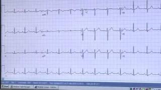 Code STEMI: Heart Attack Survival