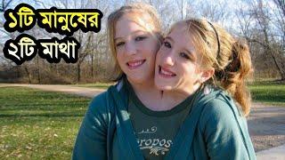 একটি শরীরে দুই মাথার জমজ মানুষ। Strange twin people