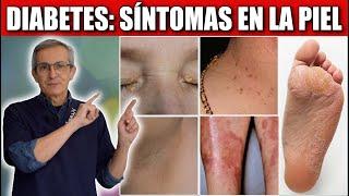 10 SINTOMAS de DIABETES en la PIEL