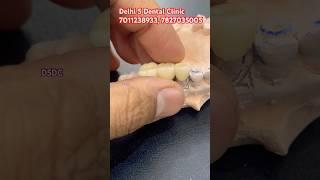 This dental bridge ‼️ | Pfm bridge | Delhi 5 dental clinic | best dentist in karol bagh new delhi