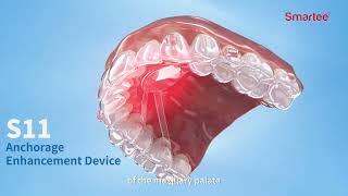 Smartee S11 Palatal Device ( Horizontal arch expansion & Anchorage enhancement)