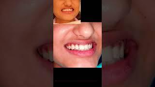 Happiest Day in Life- New Smile #braces #fullmouthdentalimplants #bestdentistindelhi