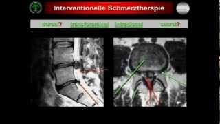 Interventionelle Schmerztherapie und -diagnostik im nicht-operativen Behandlungskonzept