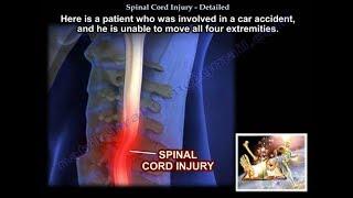 Spinal Cord Injury, Detailed  - Everything You Need To Know - Dr. Nabil Ebraheim