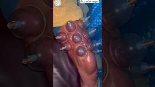 Cupping therapy on leg / relief pain hijama therapy #therapy #shorts