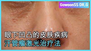 汗管瘤激光治疗法 Korean Dermatology Clinic to syringoma [한관종 치료]