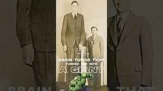 It’s a pituitary adenoma. #medical #doctor #braintumor #transphenoidal #gigantism #acromegaly