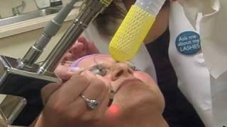 Micro Laser Peel with Dr. Linda Huang