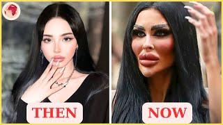 23 Top Celebrity Plastic Surgery Disasters | Then and Now 2025