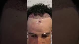 Trasplante capilar resultado | Injerto capilar sin rasurar | Hair transplant before after