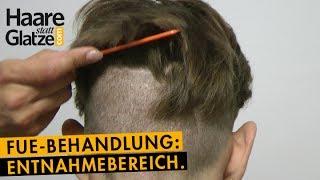 FUE-Haartransplantation: So sieht der Spenderbereich nach 6 Tagen aus