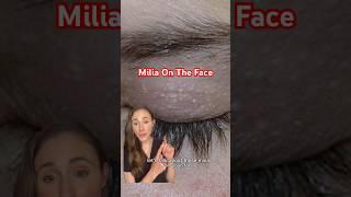 Get Rid Of Your Milia For Good! #dermatologist