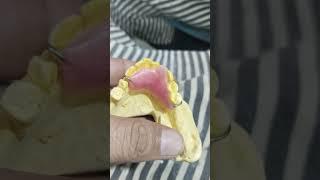 Single Unit Removable Partial Denture By Haider #rpddentalprocedure #rpd #dentures