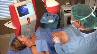 GPS Laser Lipo Procedure with Dr. Castor