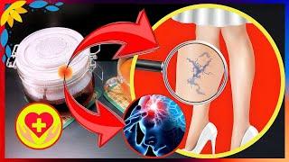 Varicose Vein Remedy: Improves Circulation and Memory in 7 Days! Vessel Cleansing