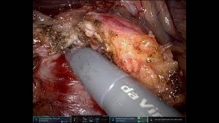 Narrated robotic Whipple for pancreatic cancer.