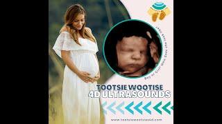 Tootsie Wootsies 4D Ultrasound