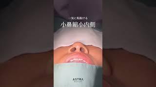 【小鼻縮小だけでここまで変わる⁉︎】 #鼻整形 #美容整形 #astrabeautyclinic #小鼻縮小