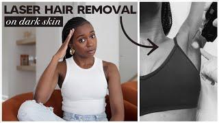 Getting Laser Hair Removal On My Dark Skin  | Cost, Safety, Full Brazilian, Ingrown Hairs