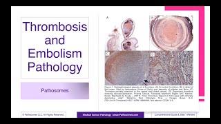 Thrombosis and Embolism Pathology | Comprehensive Guide & Step 1 Review | Pathology Step 1 USMLE