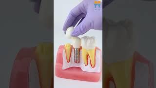 iDENTical Implant Analysis Model M2017 - Essential Dental Education Tool #shorts #dentalkart