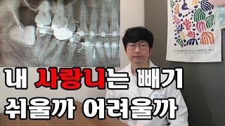 How to know if pulling out a wisdom tooth is easy or difficult(내 사랑니가 빼기 쉬운걸까 어려운 걸까 알아보는 법)