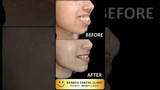 Gummy Smile Treatment in Delhi @ Bandhu Dental Clinic