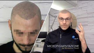 La soluzione contro le calvizie.. come prendere la decisione giusta? | ER Micropigmentazione Udine