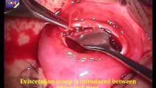 EVISCERATION OF EYE || EVISCERATION with Acrylic Implant