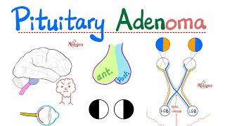 Pituitary Adenoma - Pituitary Tumors - Prolactinoma - Microadenoma, Macroadenoma - Visual Field