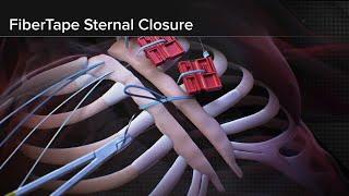 Introducing FiberTape® Sternal Closure