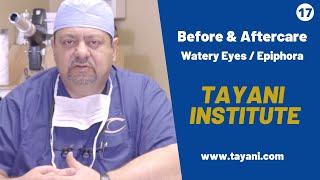 What Causes Watery Eyes? | With Dr. Tayani