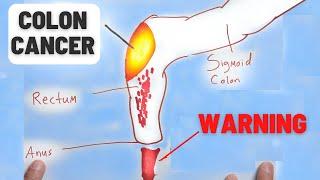 4 Warning Signs of Colon Cancer You Should NEVER Ignore