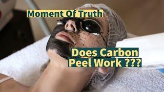 Carbon laser Peel ...Does It work ???