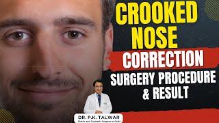 Crooked Nose Correction Surgery Procedure and Results | Rhinoplasty Surgery in Delhi | Dr. PK Talwar