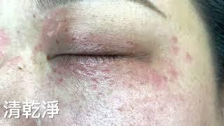 眼周汗管瘤 二氧化碳雷射清除 Syringoma, Eyelid, CO2 laser, Dr George